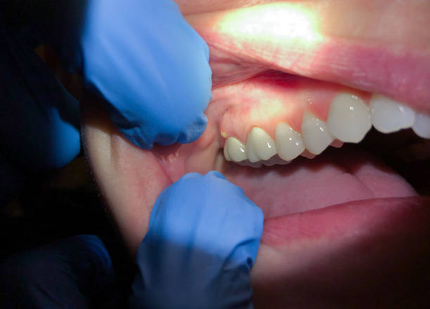 Best Emergency Dental Services for Seniors in Aumsville, OR